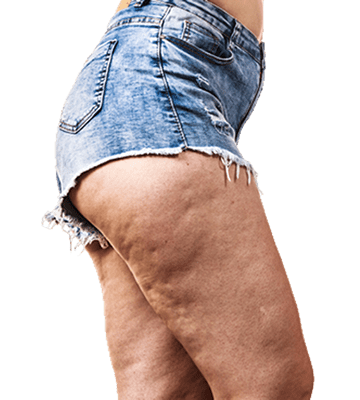cellulite-skin-thighs-2-min